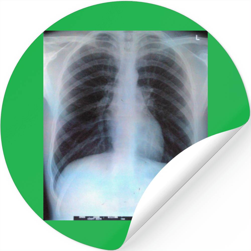 Chest X Ray Stickers